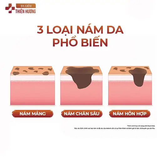 8 Sai Lầm Điều Trị Nám Da Gây Hậu Quả Nghiêm Trọng & Cách Khắc Phục