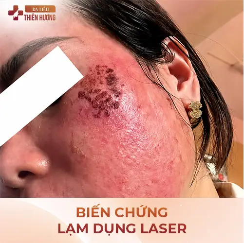 8 Sai Lầm Điều Trị Nám Da Gây Hậu Quả Nghiêm Trọng & Cách Khắc Phục