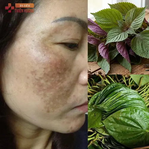 8 Sai Lầm Điều Trị Nám Da Gây Hậu Quả Nghiêm Trọng & Cách Khắc Phục
