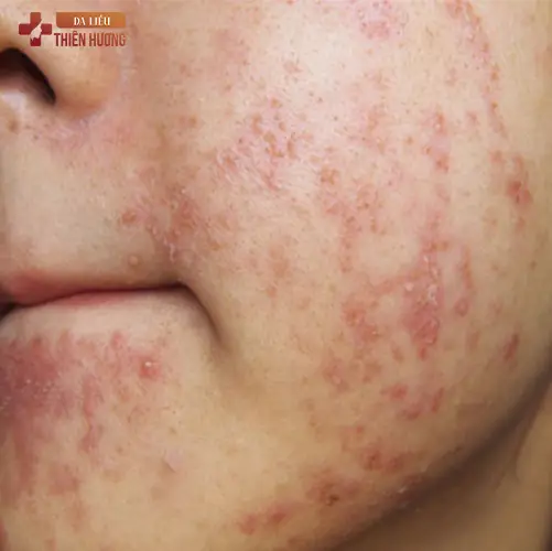8 Sai Lầm Điều Trị Nám Da Gây Hậu Quả Nghiêm Trọng & Cách Khắc Phục