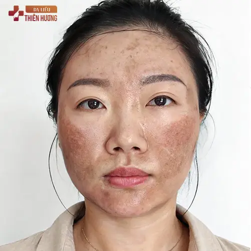 8 Sai Lầm Điều Trị Nám Da Gây Hậu Quả Nghiêm Trọng & Cách Khắc Phục