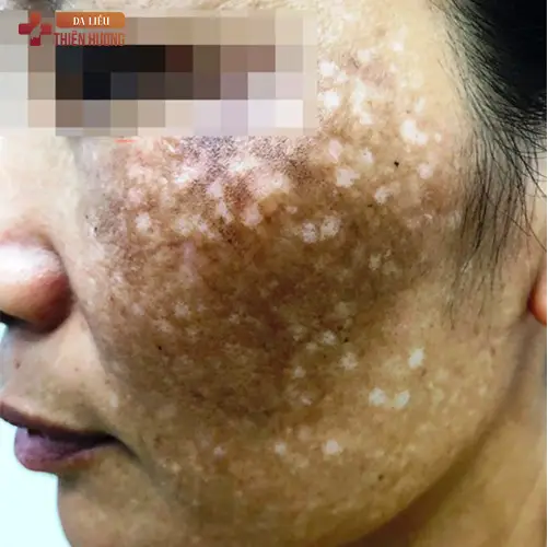 8 Sai Lầm Điều Trị Nám Da Gây Hậu Quả Nghiêm Trọng & Cách Khắc Phục