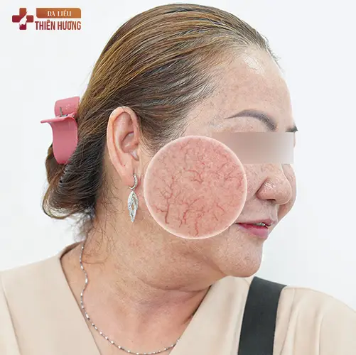 8 Sai Lầm Điều Trị Nám Da Gây Hậu Quả Nghiêm Trọng & Cách Khắc Phục