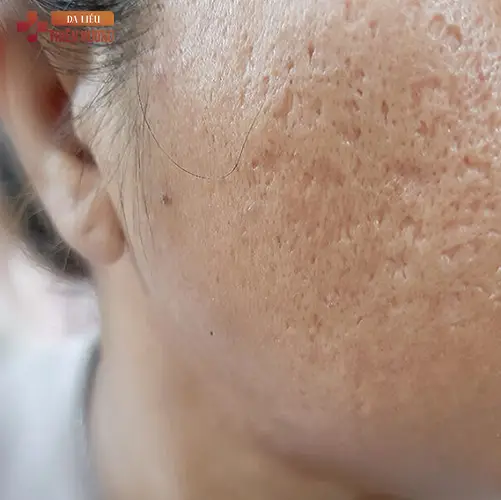 8 Sai Lầm Điều Trị Nám Da Gây Hậu Quả Nghiêm Trọng & Cách Khắc Phục