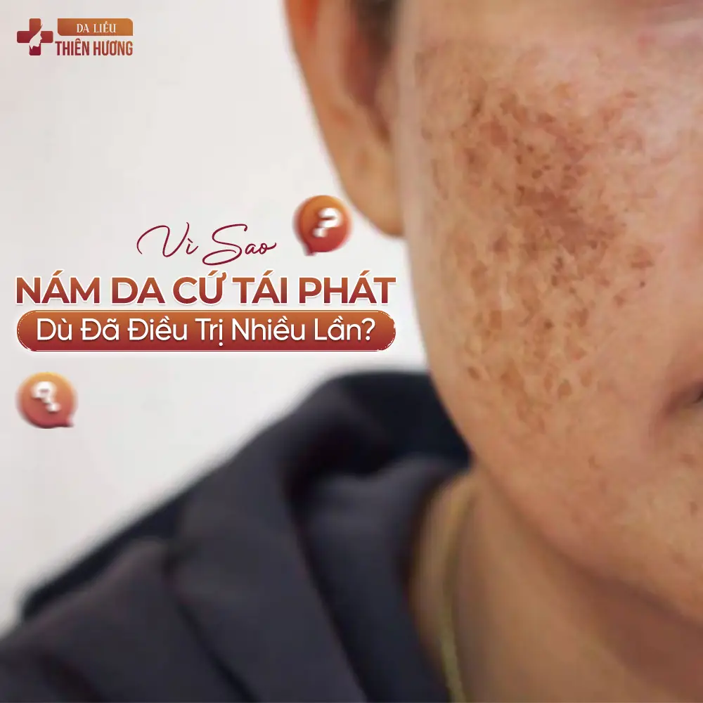 Vì Sao Nám Da Cứ Tái Phát Dù Đã Điều Trị Nhiều Lần?