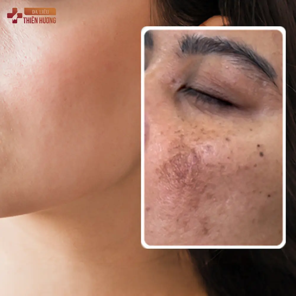 Vì Sao Nám Da Cứ Tái Phát Dù Đã Điều Trị Nhiều Lần?