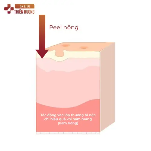 Peel Da Trị Nám: Hiệu Quả & Chi Phí