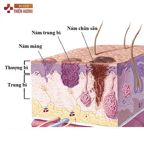 Peel Da Trị Nám: Hiệu Quả & Chi Phí
