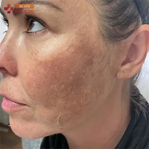 Peel Da Trị Nám: Hiệu Quả & Chi Phí