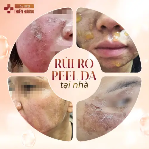 Peel Da Trị Nám: Hiệu Quả & Chi Phí