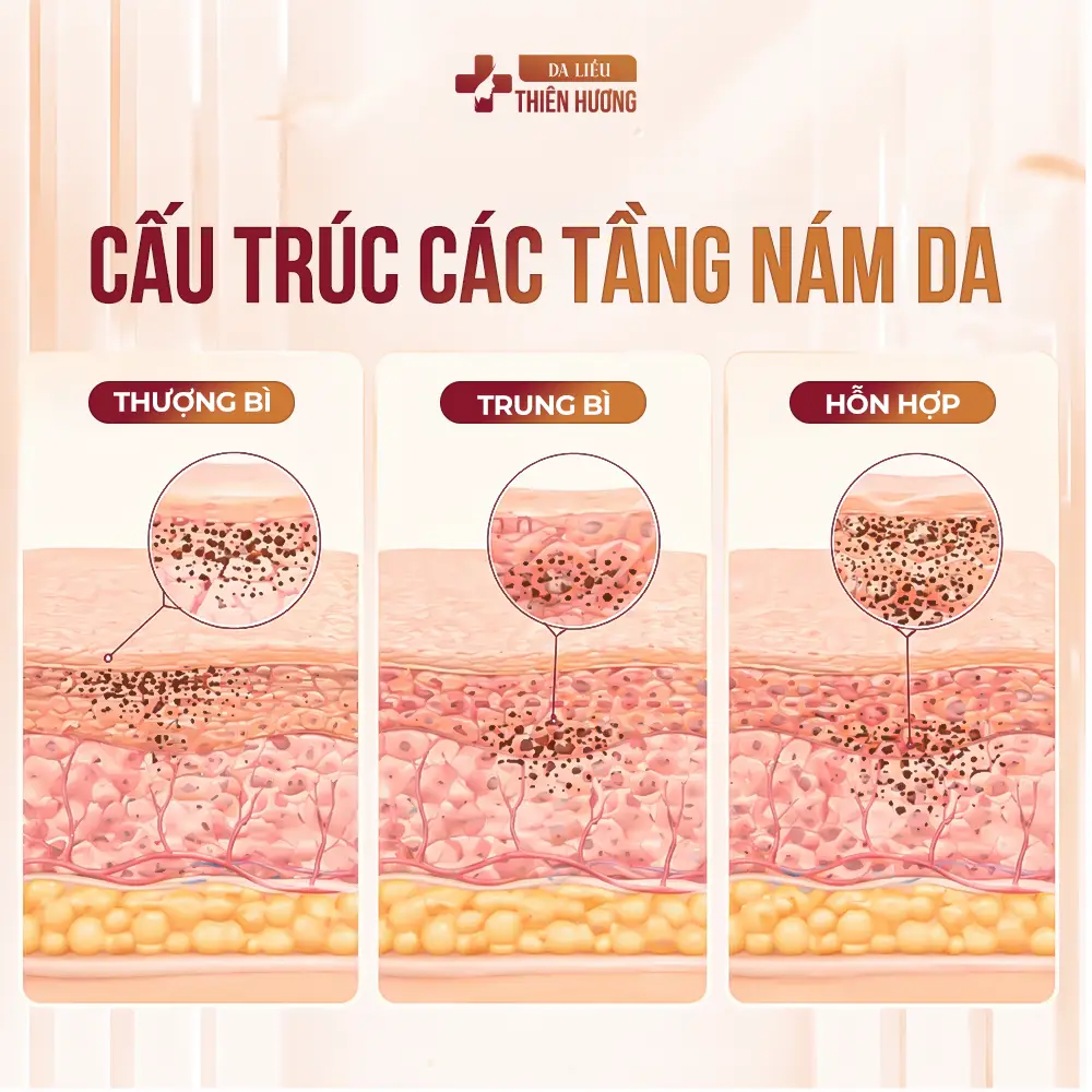 Phác Đồ Điều Trị Nám Da Chuẩn Y Khoa: 4 Giai Đoạn & Từng Phác Đồ Cho 3 Loại Nám