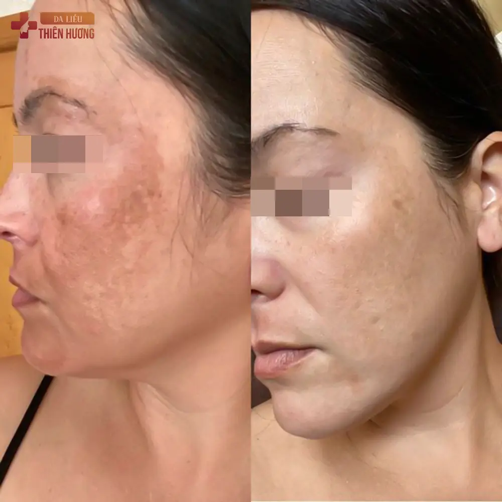 Phác Đồ Điều Trị Nám Da Chuẩn Y Khoa: 4 Giai Đoạn & Từng Phác Đồ Cho 3 Loại Nám
