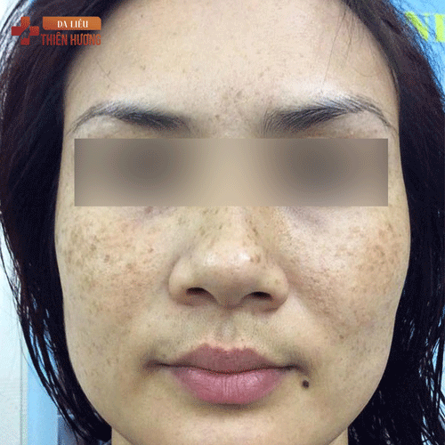 Cách Phòng Ngừa Nám Da: 9 Biện Pháp Hiệu Quả Được Bác Sĩ Khuyến Nghị