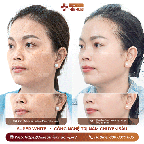 Cách Phòng Ngừa Nám Da: 9 Biện Pháp Hiệu Quả Được Bác Sĩ Khuyến Nghị