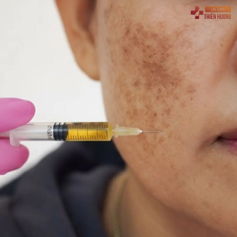 Trị Nám Bằng PRP: Hiệu Quả, Chi Phí & Quy Trình Thực Hiện