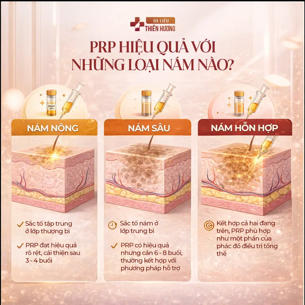 Trị Nám Bằng PRP: Hiệu Quả, Chi Phí & Quy Trình Thực Hiện