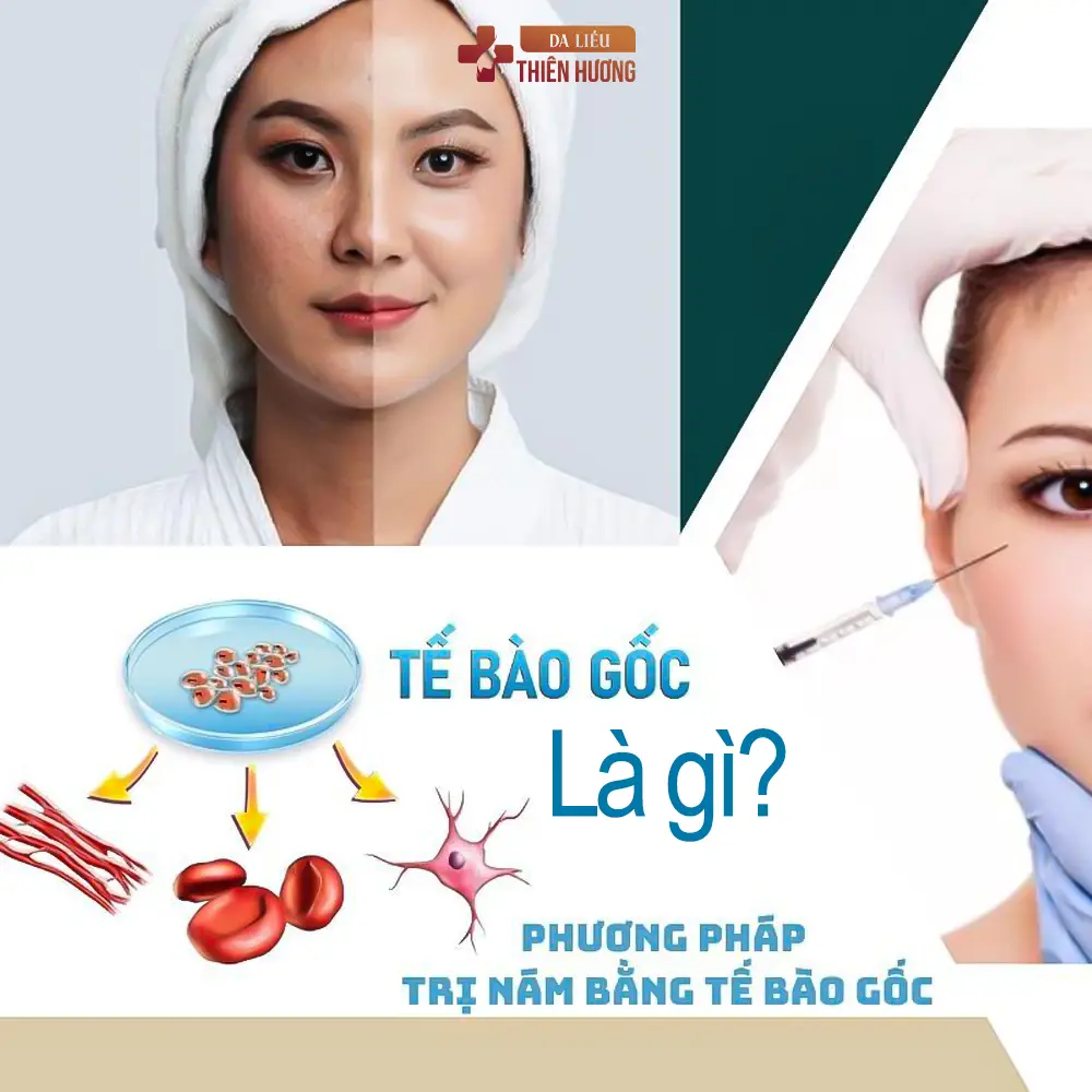 Tế Bào Gốc Trị Nám: Cơ Chế, Phương Pháp & Hiệu Quả Thực Sự