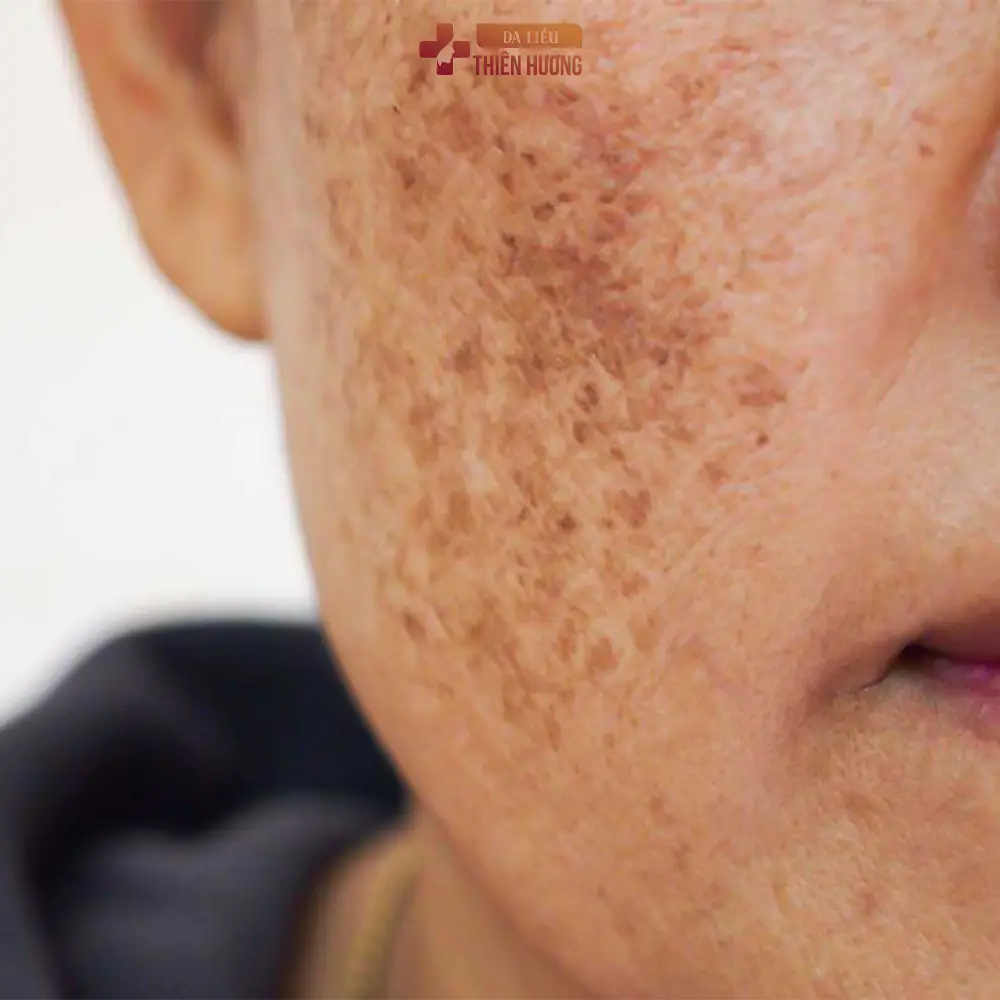 Tế Bào Gốc Trị Nám: Cơ Chế, Phương Pháp & Hiệu Quả Thực Sự