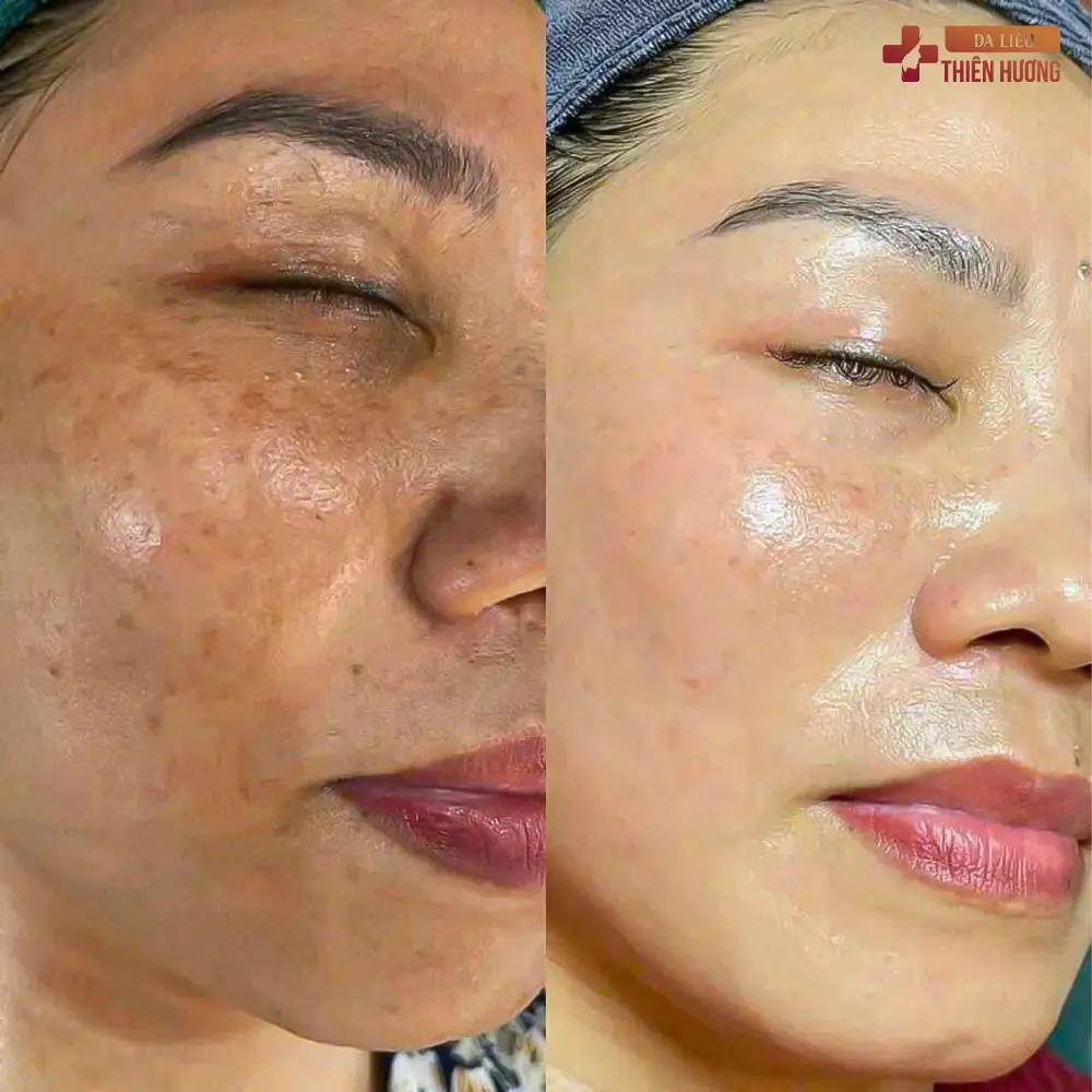 Tế Bào Gốc Trị Nám: Cơ Chế, Phương Pháp & Hiệu Quả Thực Sự