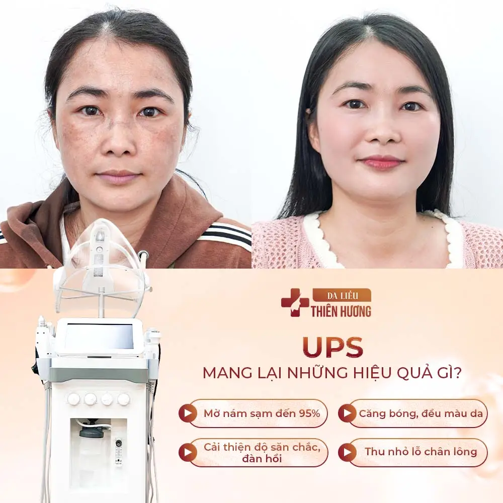 Thuốc Tránh Thai Có Gây Nám Da Không? Sự Thật Ít Ai Biết