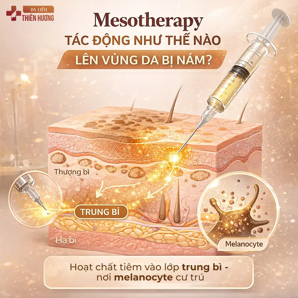 Tiêm Meso Trị Nám: Hiệu Quả, Ai Phù Hợp & Khi Nào Nên Làm?