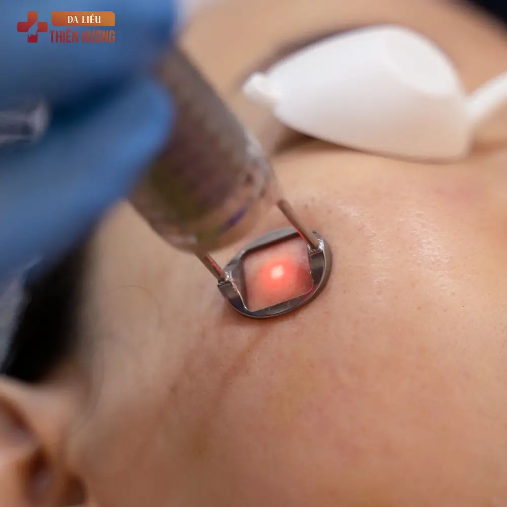 Trị nám da bao nhiêu tiền? Bảng giá trị nám tại TP.HCM
