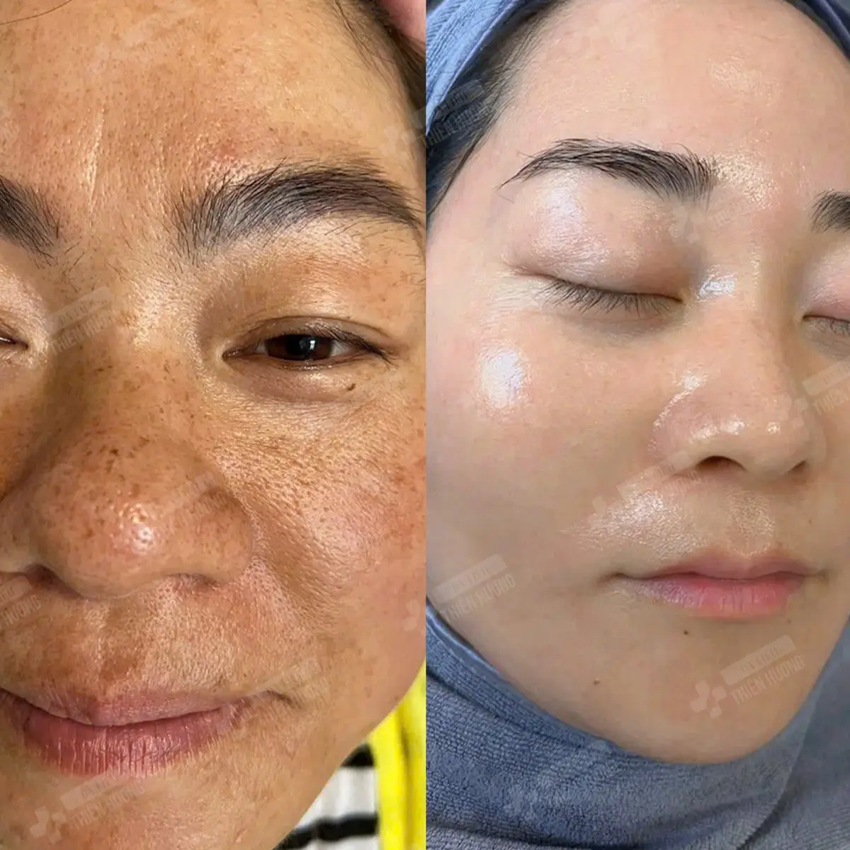Video – Hình Ảnh Kết Quả Khách Hàng Điều Trị Nám Da