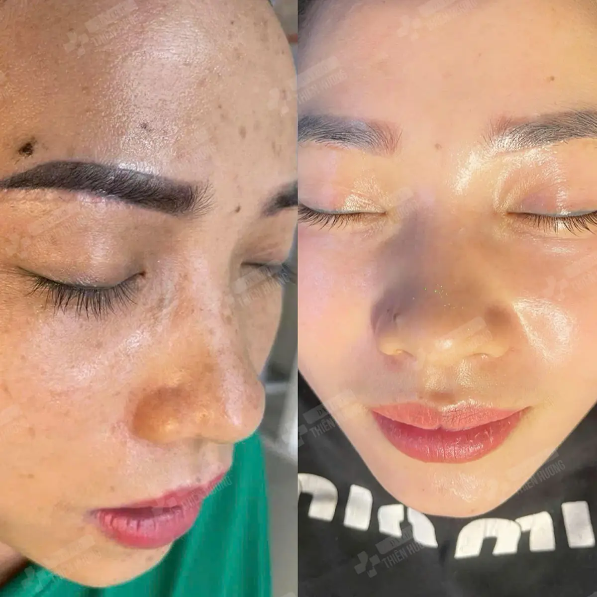 Video – Hình Ảnh Kết Quả Khách Hàng Điều Trị Nám Da