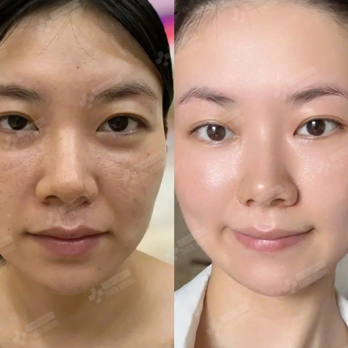 Video – Hình Ảnh Kết Quả Khách Hàng Điều Trị Nám Da