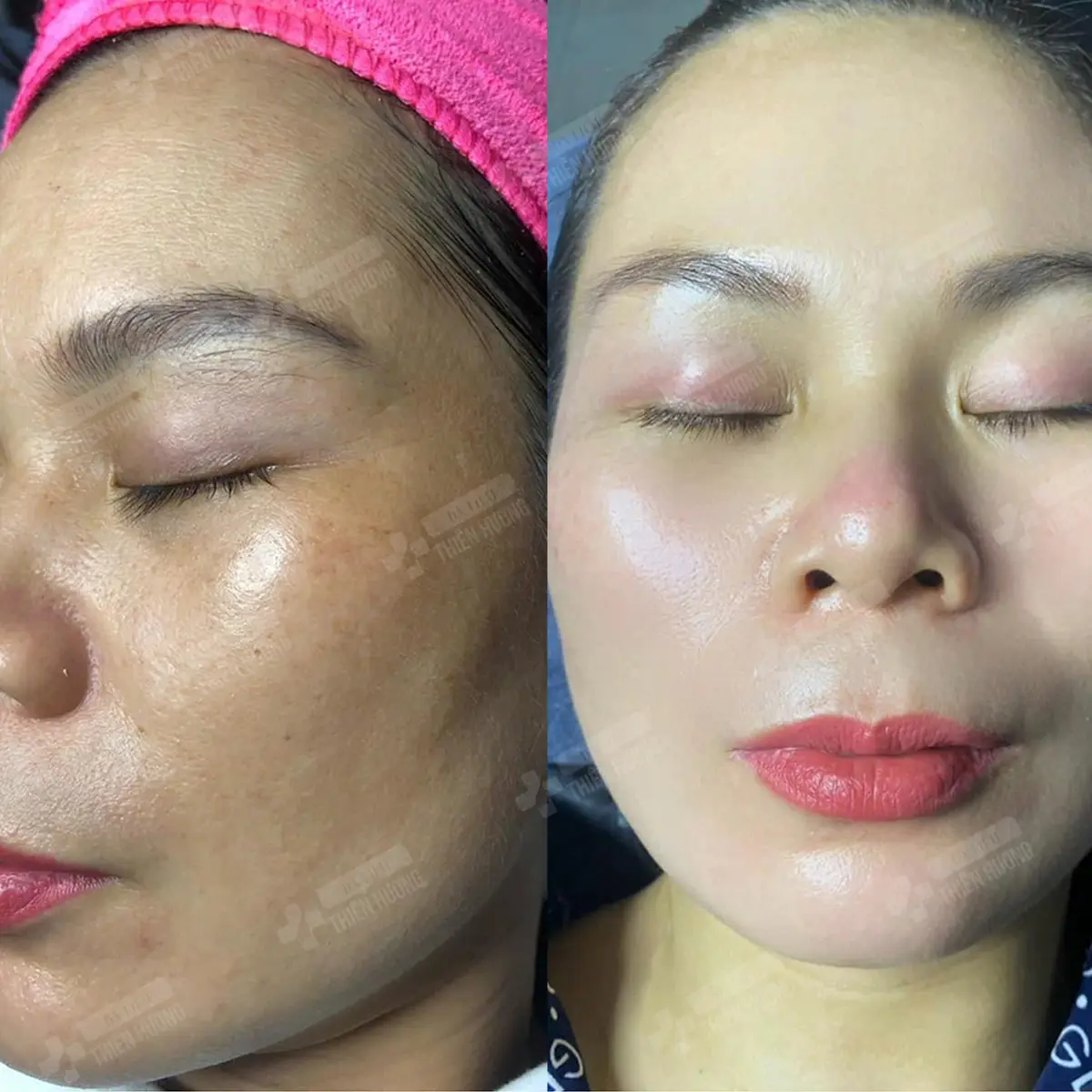 Video – Hình Ảnh Kết Quả Khách Hàng Điều Trị Nám Da