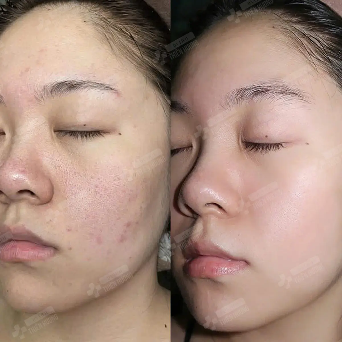 Video – Hình Ảnh Kết Quả Khách Hàng Điều Trị Nám Da