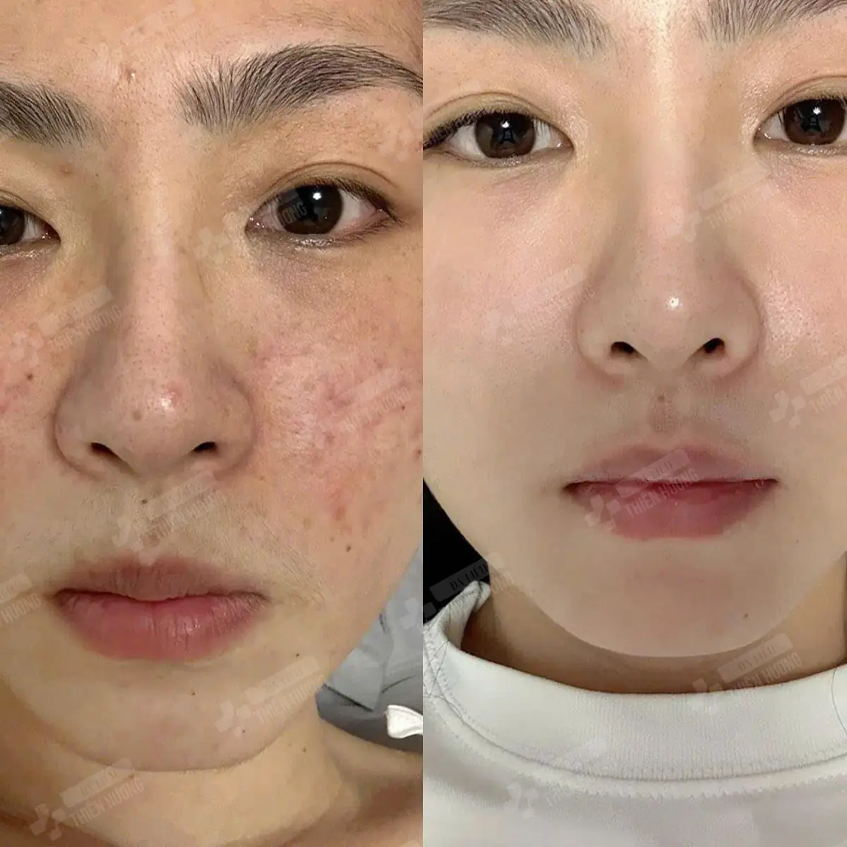 Video – Hình Ảnh Kết Quả Khách Hàng Điều Trị Nám Da