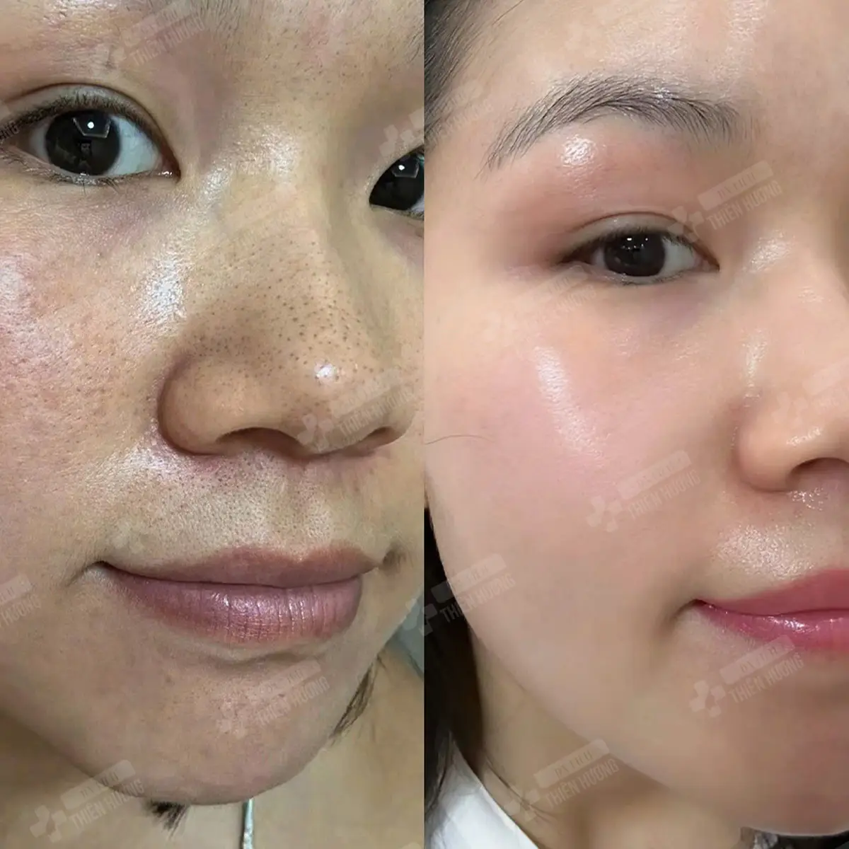 Video – Hình Ảnh Kết Quả Khách Hàng Điều Trị Nám Da