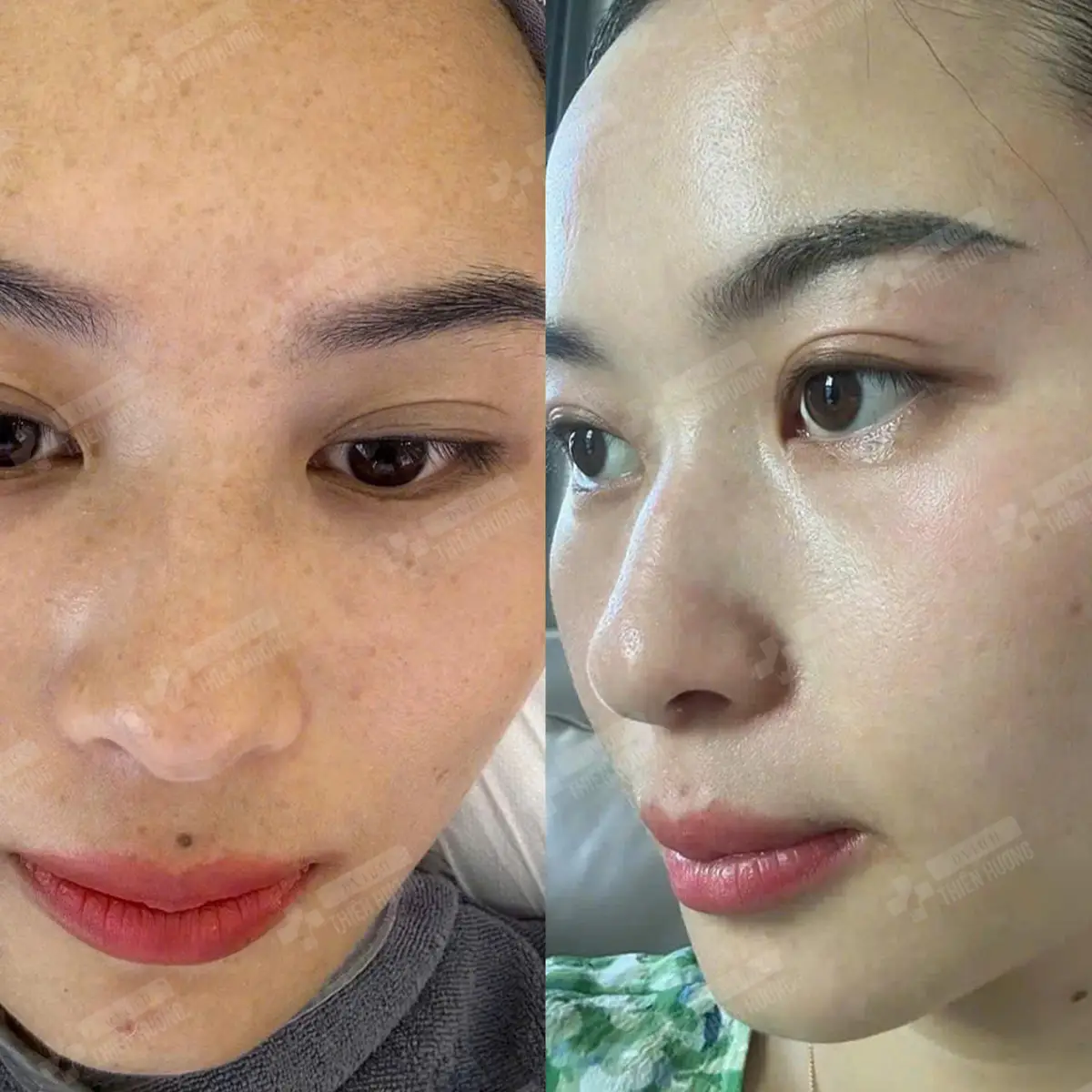 Video – Hình Ảnh Kết Quả Khách Hàng Điều Trị Nám Da