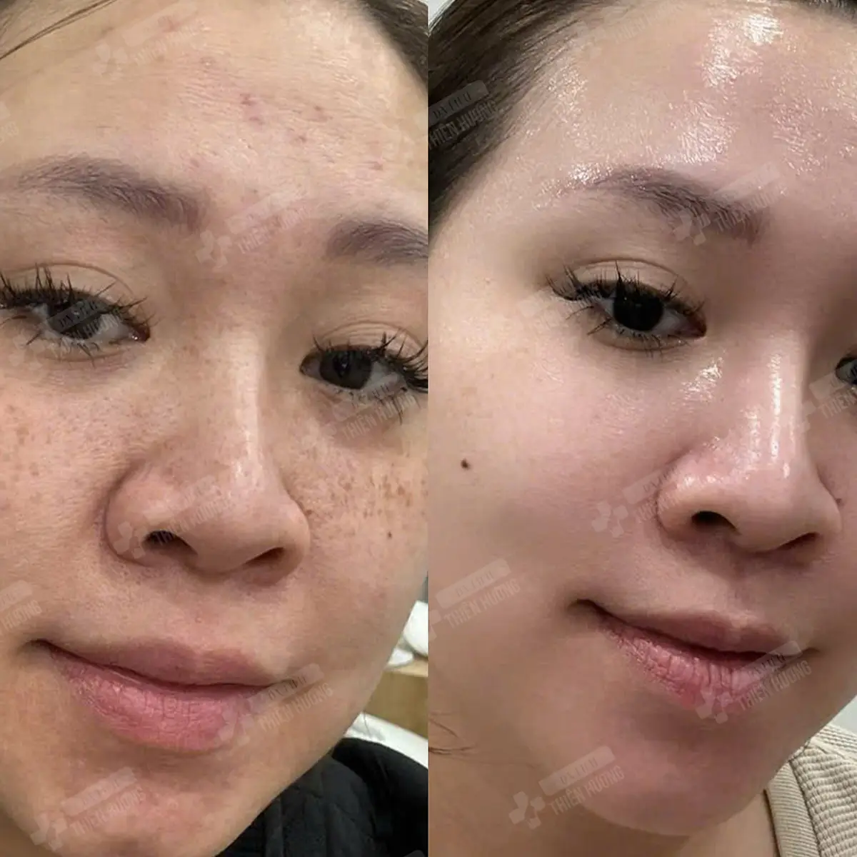 Video – Hình Ảnh Kết Quả Khách Hàng Điều Trị Nám Da
