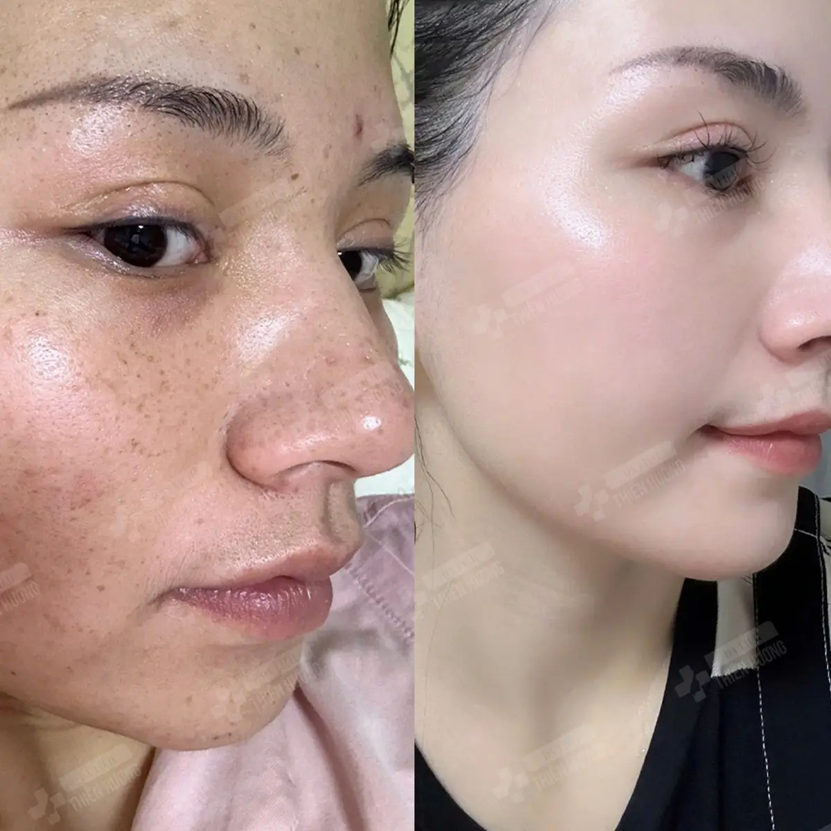 Video – Hình Ảnh Kết Quả Khách Hàng Điều Trị Nám Da
