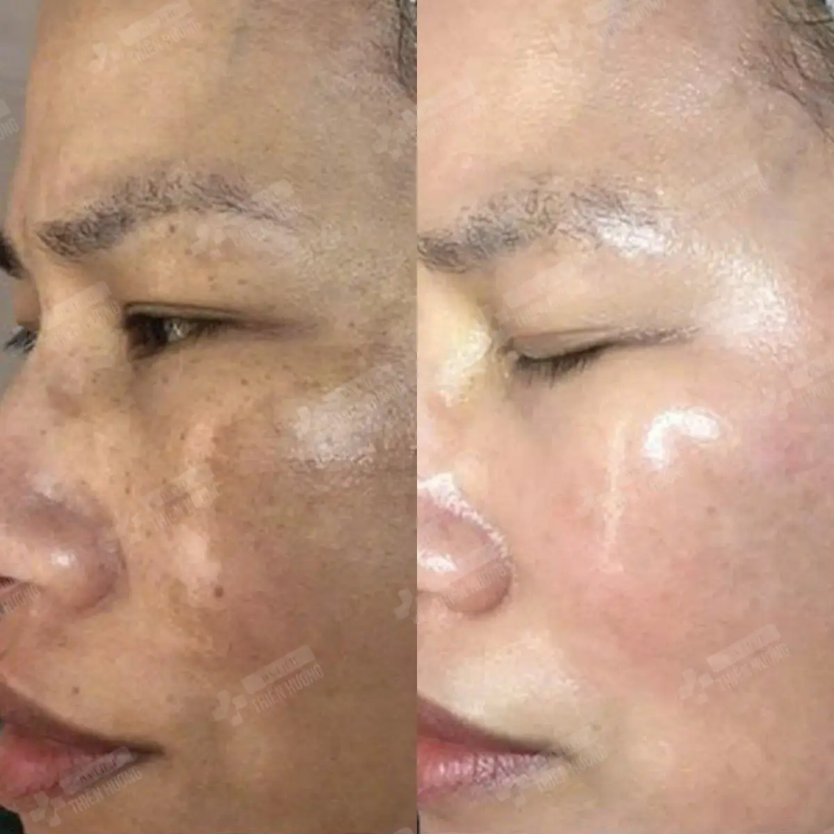 Video – Hình Ảnh Kết Quả Khách Hàng Điều Trị Nám Da