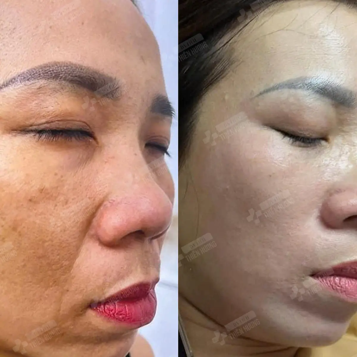 Video – Hình Ảnh Kết Quả Khách Hàng Điều Trị Nám Da