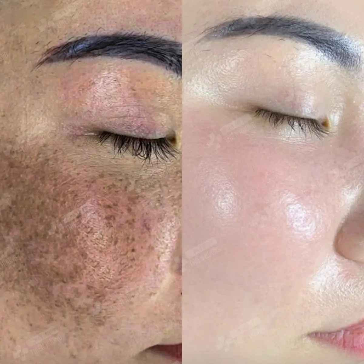 Video – Hình Ảnh Kết Quả Khách Hàng Điều Trị Nám Da