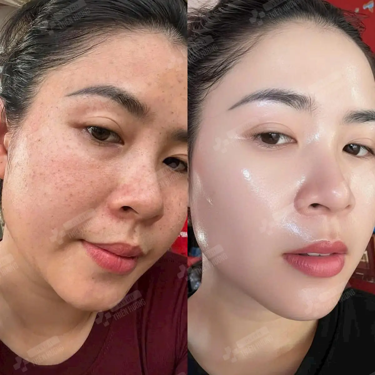 Video – Hình Ảnh Kết Quả Khách Hàng Điều Trị Nám Da