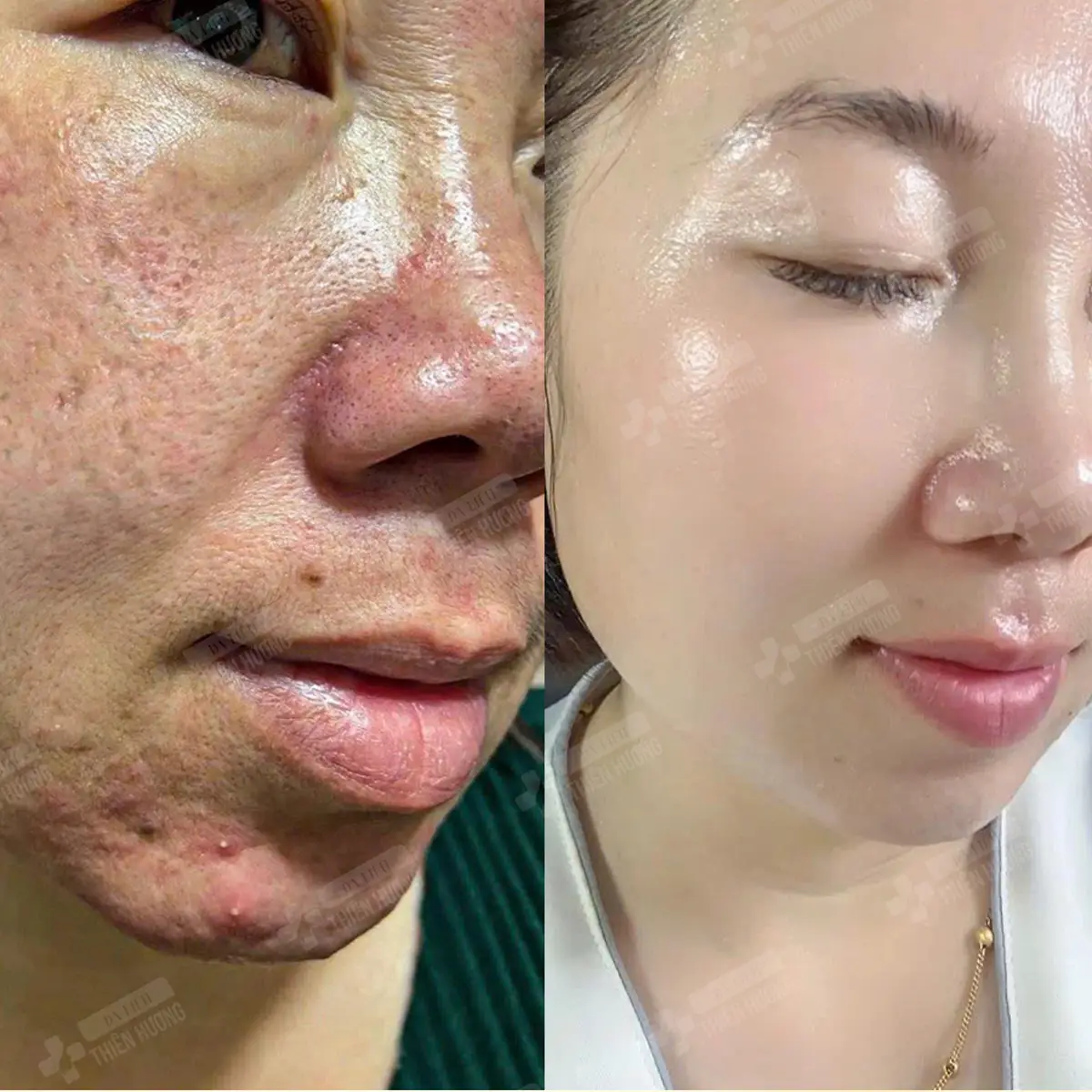 Video – Hình Ảnh Kết Quả Khách Hàng Điều Trị Nám Da