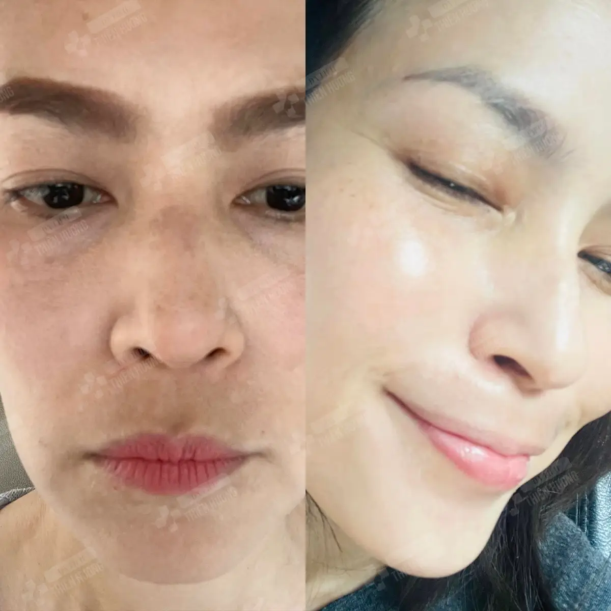 Video – Hình Ảnh Kết Quả Khách Hàng Điều Trị Nám Da