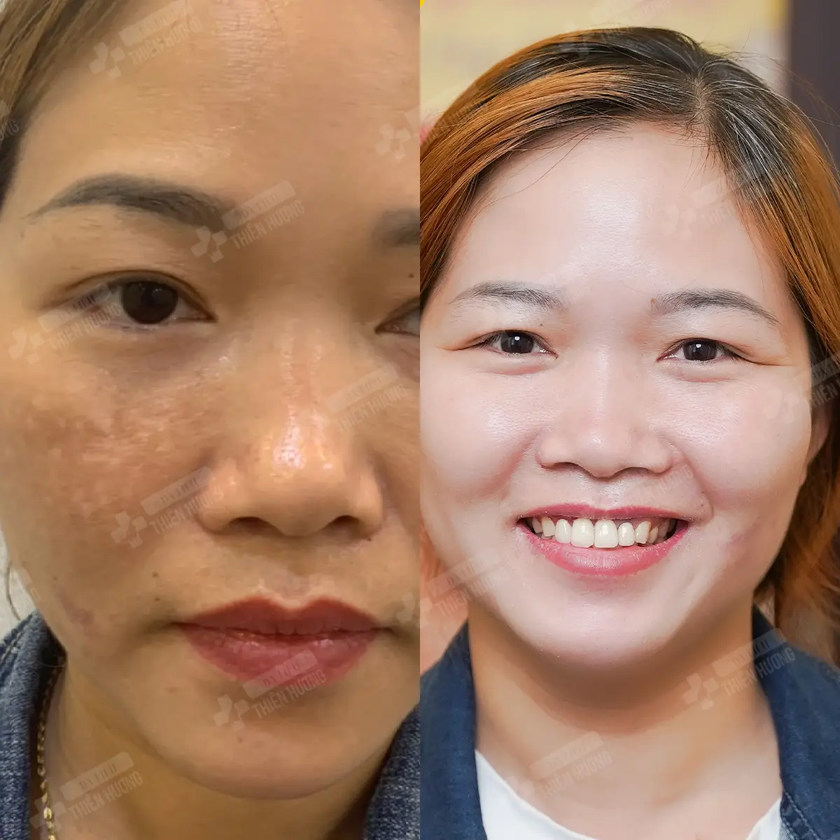 Video – Hình Ảnh Kết Quả Khách Hàng Điều Trị Nám Da