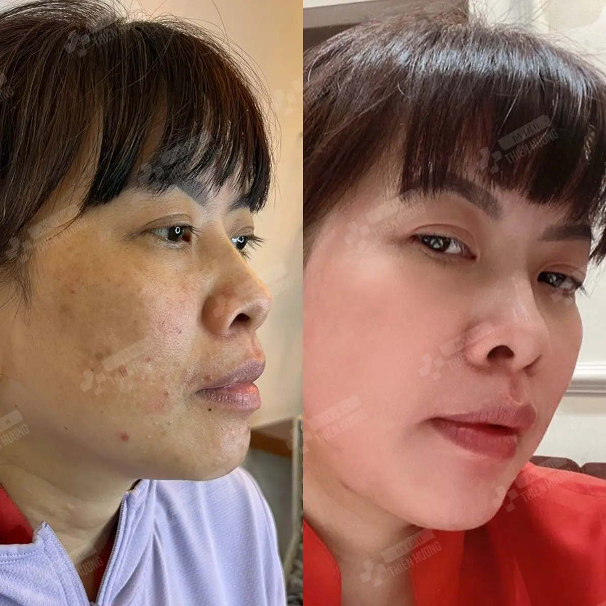 Video – Hình Ảnh Kết Quả Khách Hàng Điều Trị Nám Da