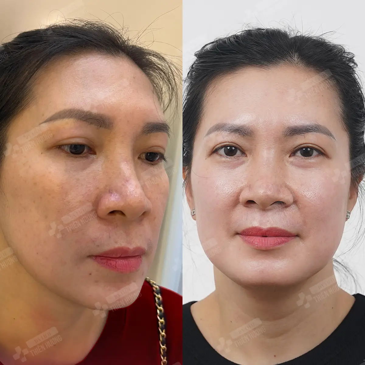 Video – Hình Ảnh Kết Quả Khách Hàng Điều Trị Nám Da