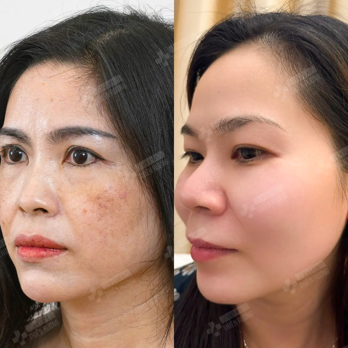 Video – Hình Ảnh Kết Quả Khách Hàng Điều Trị Nám Da