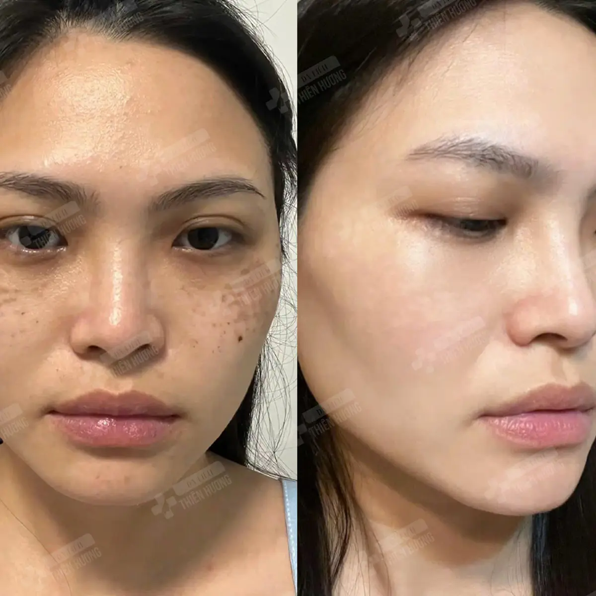 Video – Hình Ảnh Kết Quả Khách Hàng Điều Trị Nám Da