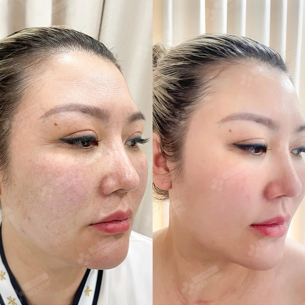 Video – Hình Ảnh Kết Quả Khách Hàng Điều Trị Nám Da