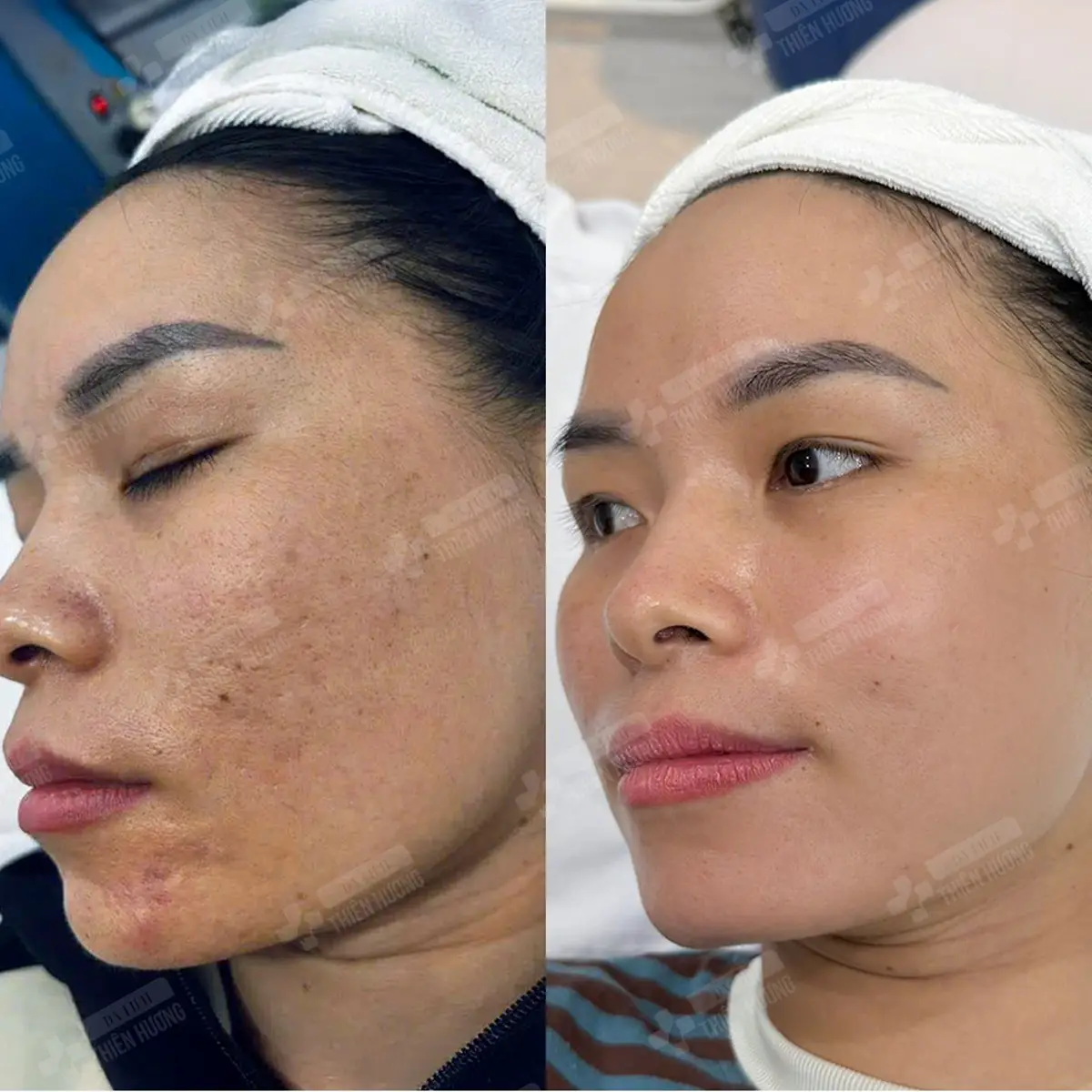 Video – Hình Ảnh Kết Quả Khách Hàng Điều Trị Nám Da