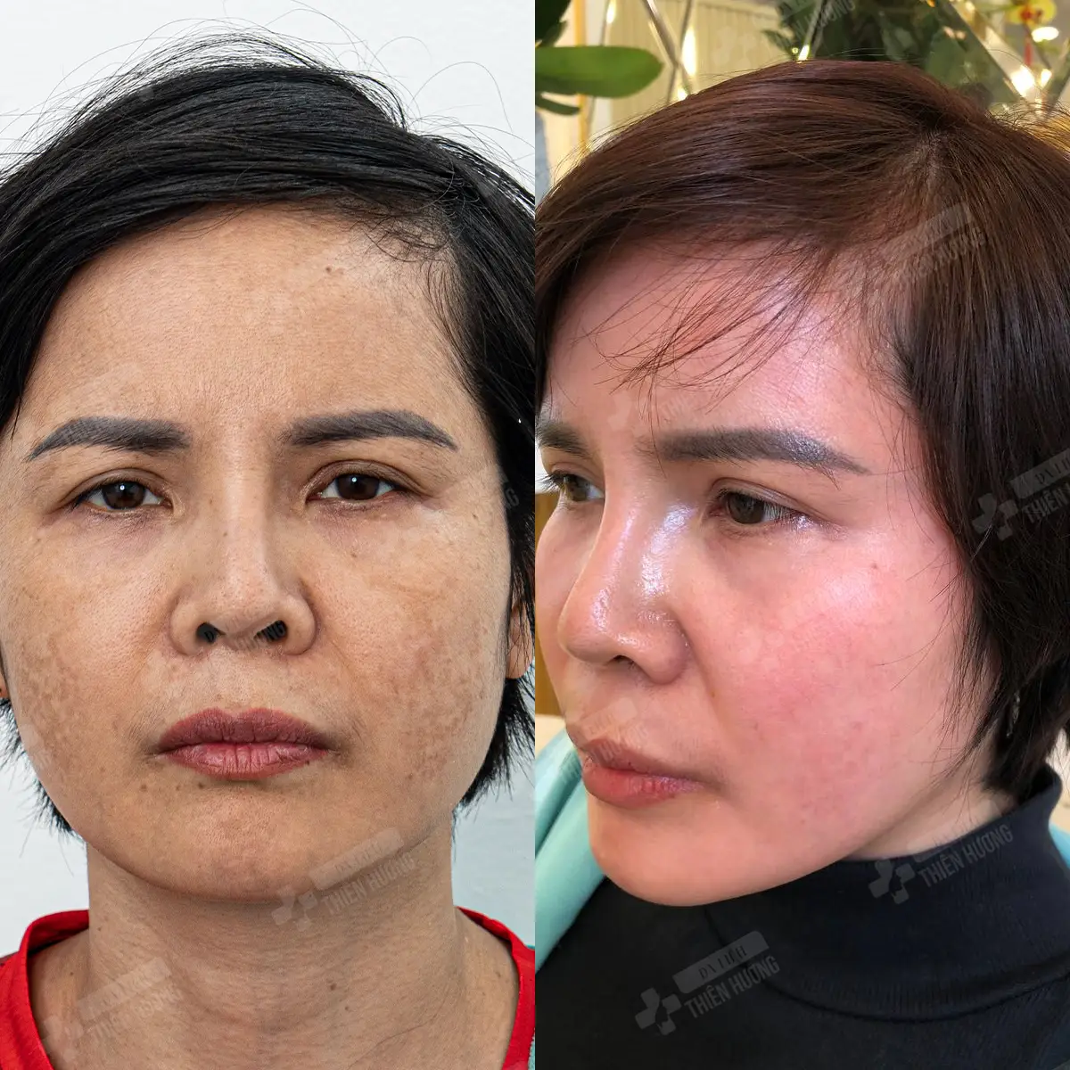 Video – Hình Ảnh Kết Quả Khách Hàng Điều Trị Nám Da